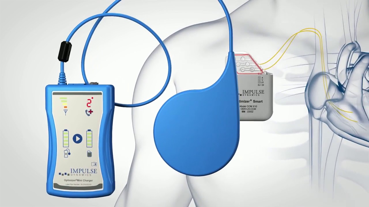 Heart Failur Implantable Device The Optimizer YouTube