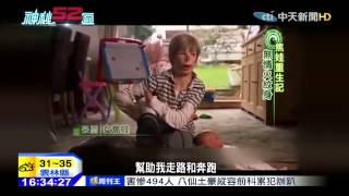 20150701中天新聞　「被火紋身的女孩」　焦娃重生記
