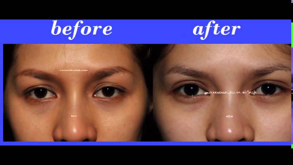 Bangkok Aesthetic Surgery Center Facial Surgery Body Surgery Cosmetic Surgery