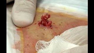 Abscessed Cyst @ Cobra's Mid-Back!