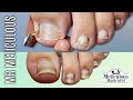 👣IMPACTED TOENAIL Gunk Removal on Mr. Meticulous👣