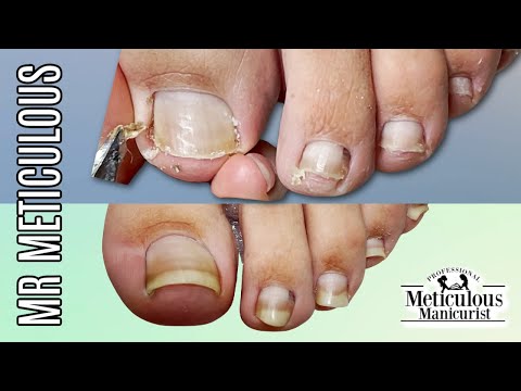 👣Pedicure Tutorial on Pincer Toenails that Cause Pain👣