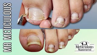 👣IMPACTED TOENAIL Gunk Removal on Mr. Meticulous👣