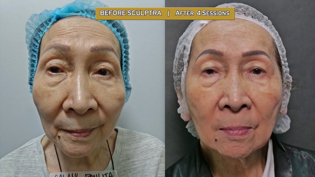 Sculptra for  80-year-old