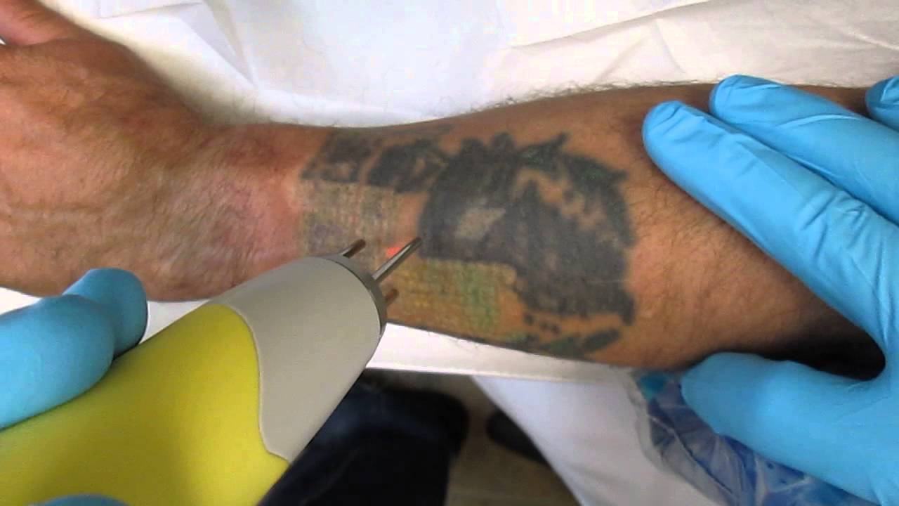 Flashpoint tattoo removal Kelowna Quanta Laser 2015 | Doovi