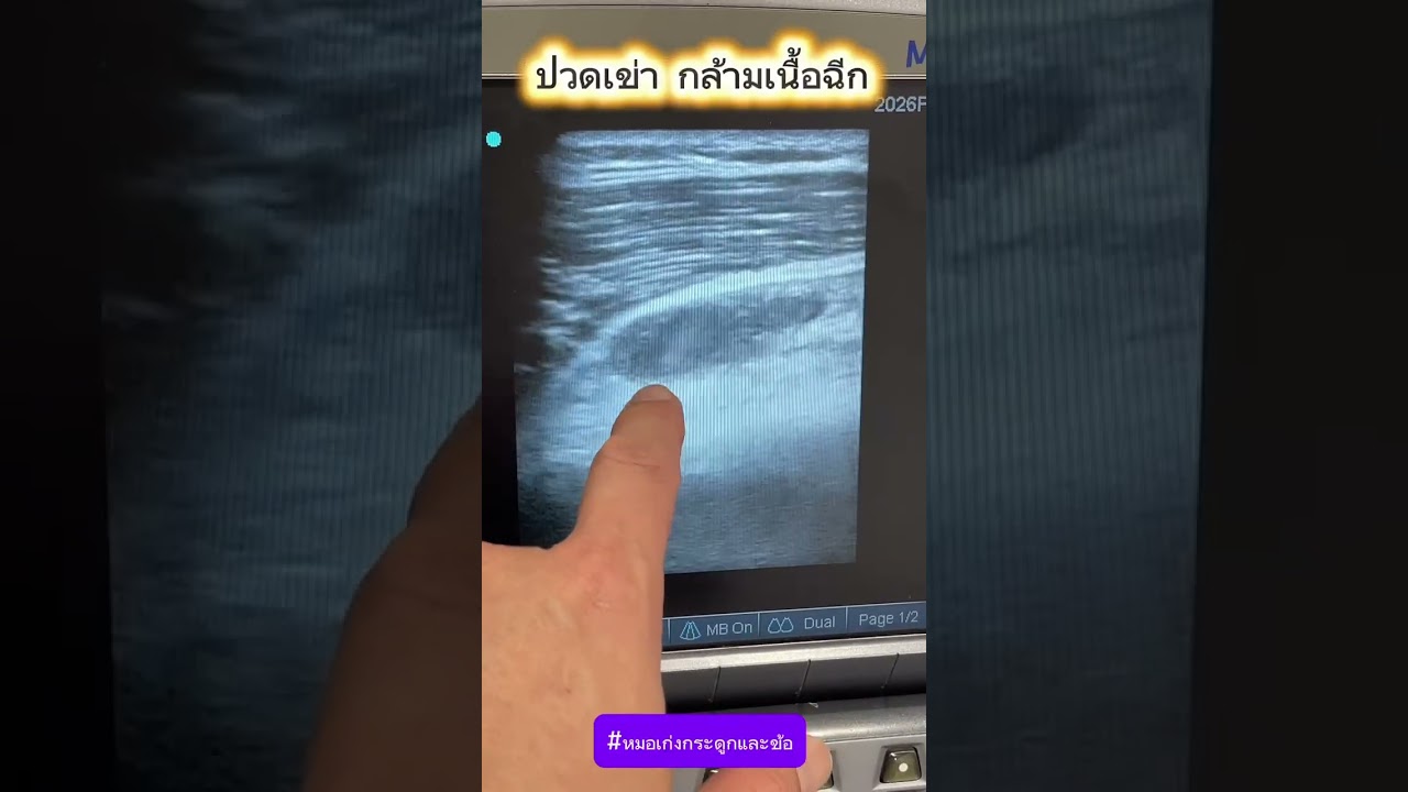 ปวดเข่า กล้ามเนื้อฉีก