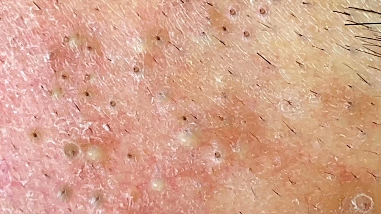 Best Pimple Popping P1