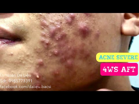 Video Mụn trứng cá mặt cực nặng|Dermatologist, pimples,... - youtube