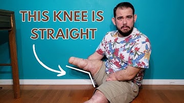 MY LEGS ARE WEIRD: Double Below Knee Amputee Can Walk on Stumps