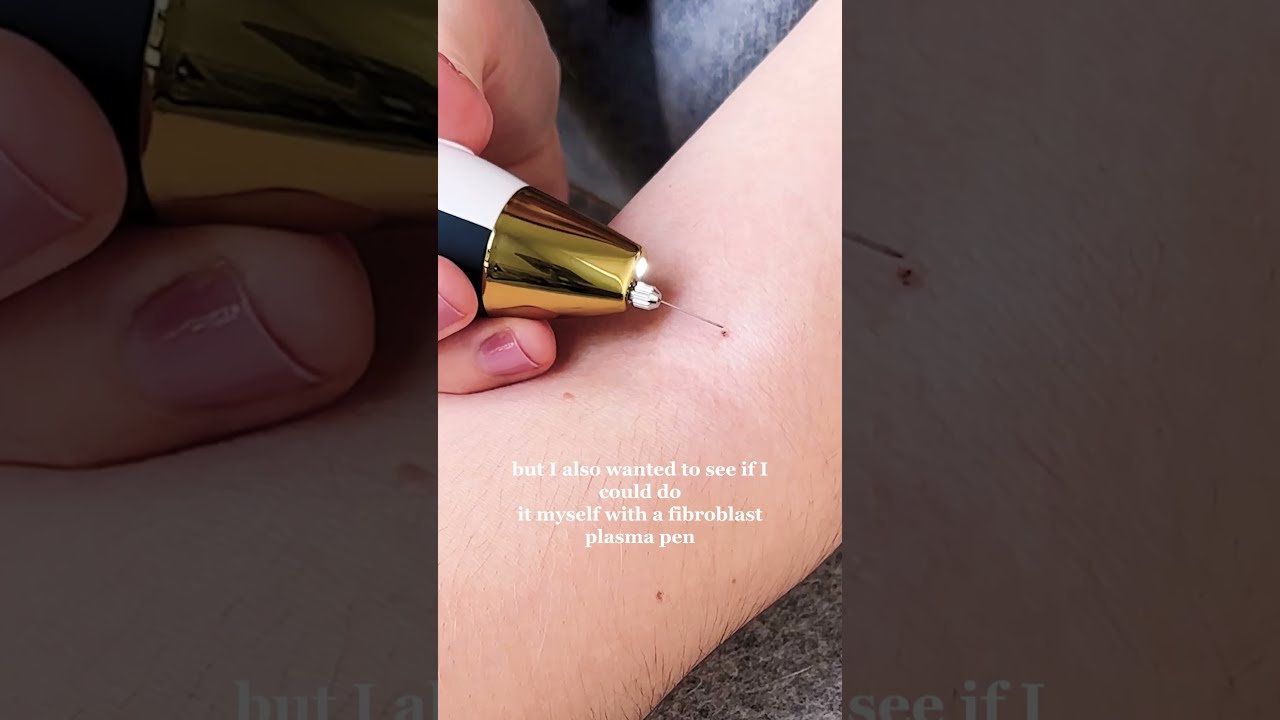 MY EXPERIENCE REMOVING SKIN TAGS AT HOME VS CLINIC Shorts