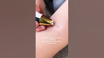MY EXPERIENCE REMOVING SKIN TAGS AT HOME VS CLINIC Shorts 