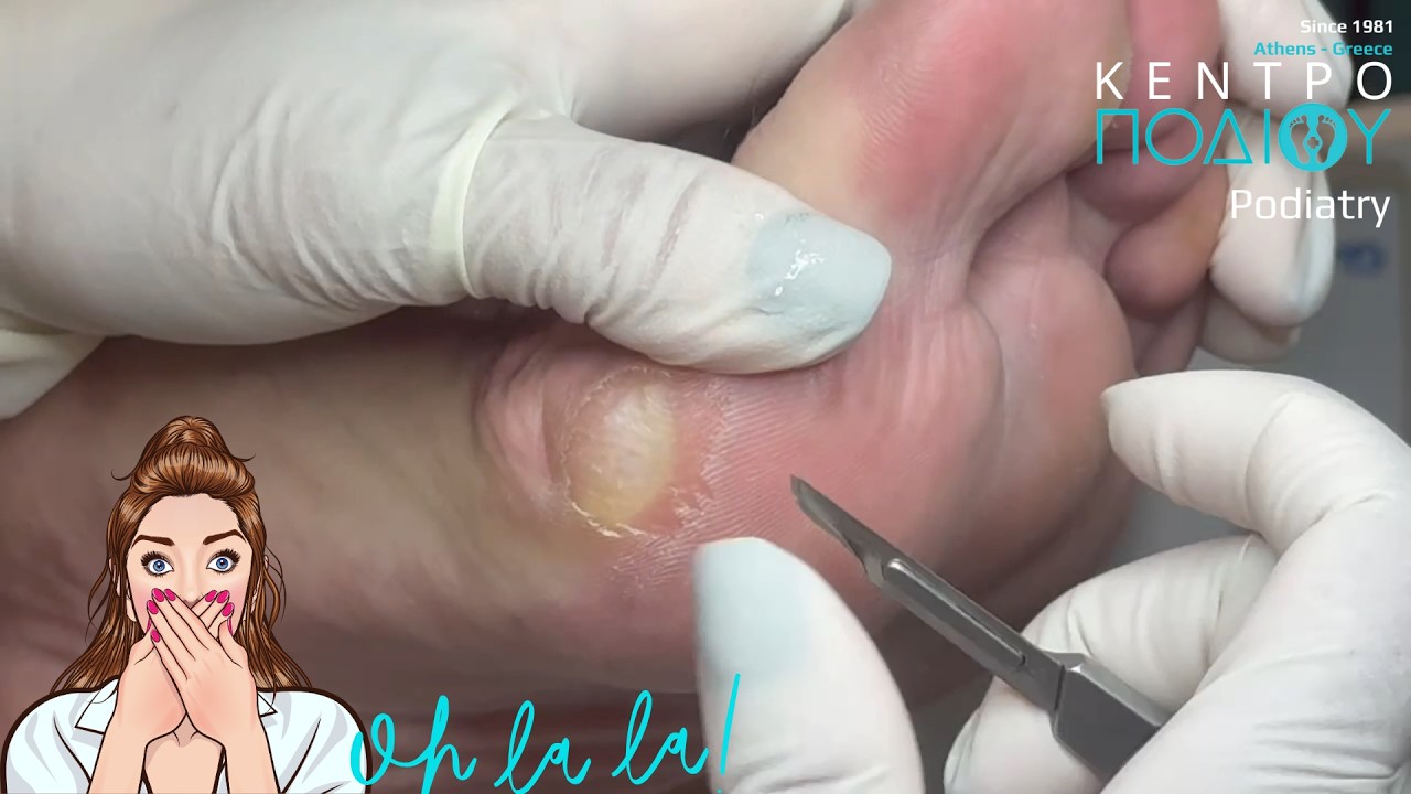 Lunula Laser Treatment for Toenail Fungus
