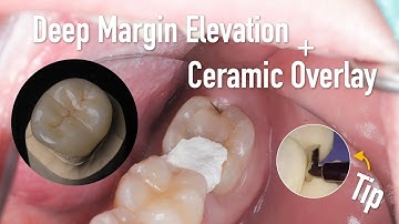 Deep margin elevation + Ceramic overlay