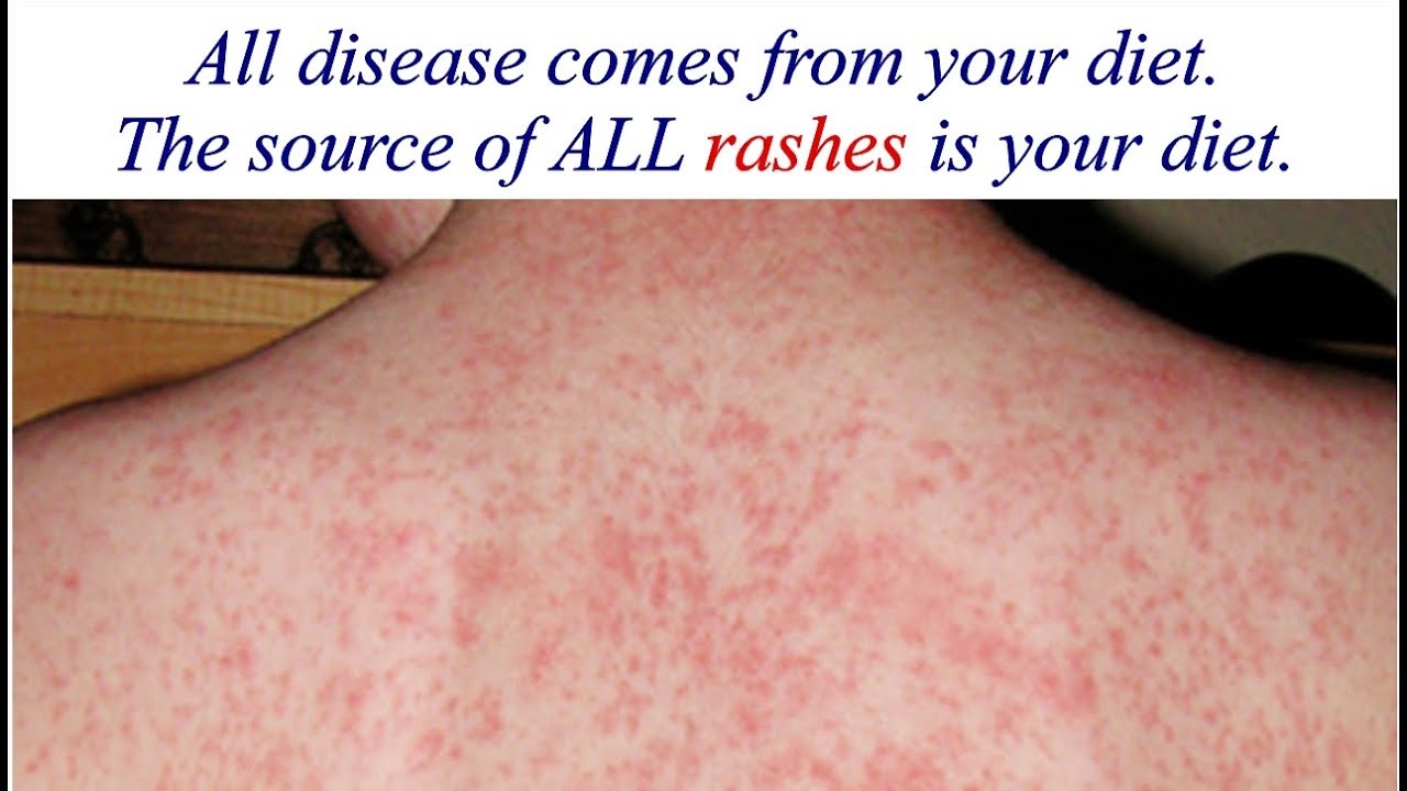 Evening Primrose Oil With Lipase For Rash Control YouTube