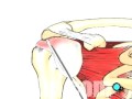 PreOp® Patient Education Rotator Cuff Repair - Arthroscopic 2