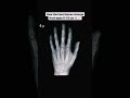 How The Hand Bones Changes From age 0-18 years#shortsfeed #newsong #song #love #shorts #bones