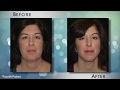 How Can Hair Grafting Help With Facial Aesthetics?