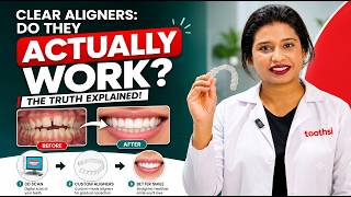 Teeth Aligners: How Toothsi Teeth Aligners Work | Step-by-step Treatment Process | Teeth Alignment
