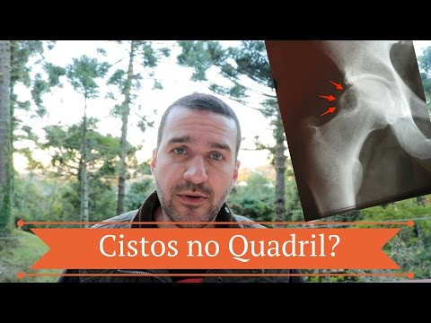 Vídeo: Esclerose Subcondral: Quadril, Formação De Cistos, Articulações Sacroilíacas, Mais