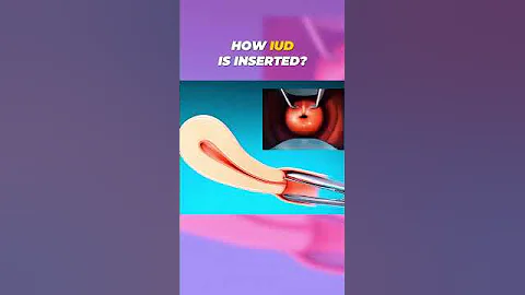 IUD Insertion Secrets You Need to Know | 3D Animation #IUDInsertion #BirthControl #medicalshorts