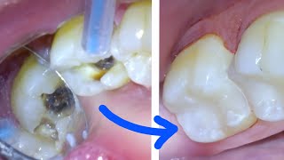 🦷 How a CAVITY & TOOTH FILLING Procedure Are Done Right by A Dentist! White Resin Composite Class 2!