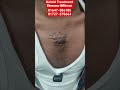 Keloid Treatment || কিলয়েড চিকিৎসা || 01647-386185 ||01727-375664