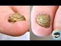 TRYING TO SAVE HER THICK DEFORMED TOENAIL!!! ***TOTAL NAIL REMOVAL***