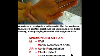Marfan Syndrome [Mnemonic]
