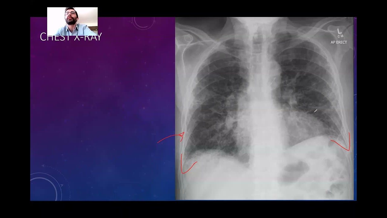 Akciğer Grafisi 6 - Vaka Değerlendirme