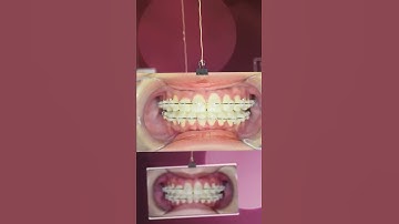 Hình ảnh trước và sau khi niềng răng hô