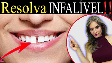 Como fechar espaço entre os dentes?