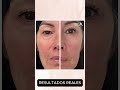 Beneficios y Resultados de Neogen Plasma | Rejuvenecimiento No Quirúrgico en Sunshine Spine & Wellne
