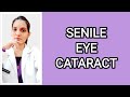 Cataractsurgeryexplained with handwritten notes dr deeksha