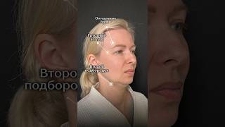 Как изменилось лицо после пластики лица❗️эндоскопический лифтинг #пластическаяоперация