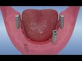 Toutes les dents sur 4 implants  all on four dentaire