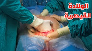 شاهد كيف تتم عمليه الولاده القيصريه لأول مره بحياتك_Watch the ...
