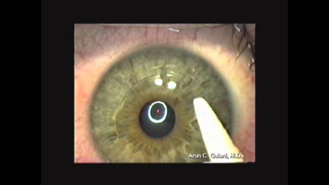Keratoconus Correction Keratoconus Correction Think Outside the Cone