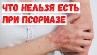 Продукты, которые нельзя есть при псориазе