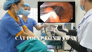 Cắt polyp lớn dạ dày qua nội soi