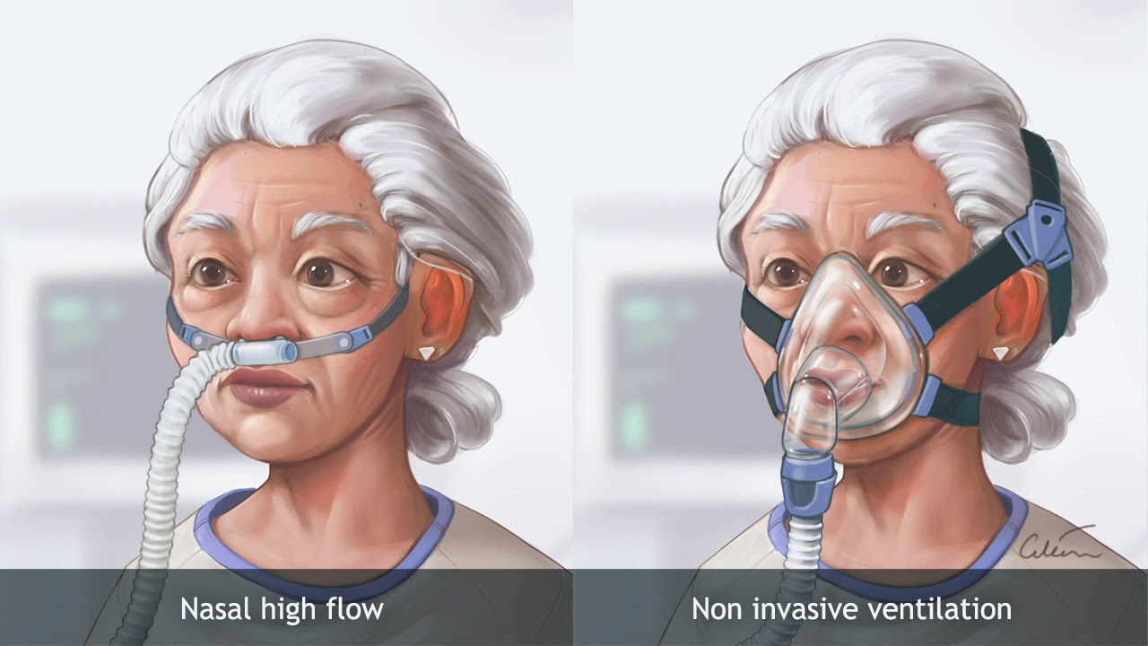 Nasal high‐flow therapy versus NIV in COPD patients with chronic  respiratory failure - YouTube