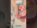 "Expert Gallstone Treatment with Laparoscopic Surgery at Khosla Stone Kidney &amp; Surgical Centre"