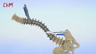 CHARSPINE2 VD - Vertebral Derotation