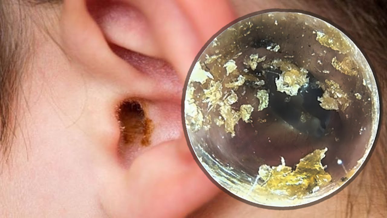 極端な耳垢の除去、extreme ear wax removal part 346 YouTube