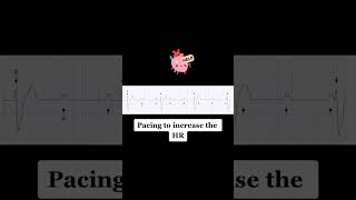 Let's talk about a complete heart block