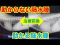 助かる肺水腫と助からない肺水腫