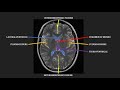 Introduction to MRI of the brain