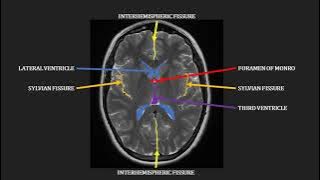Introduction to MRI of the brain