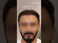 Hair Transplant Results | Hair Transplant Journey | Hair Transplant Clinic, Dubai - Bizrahmed