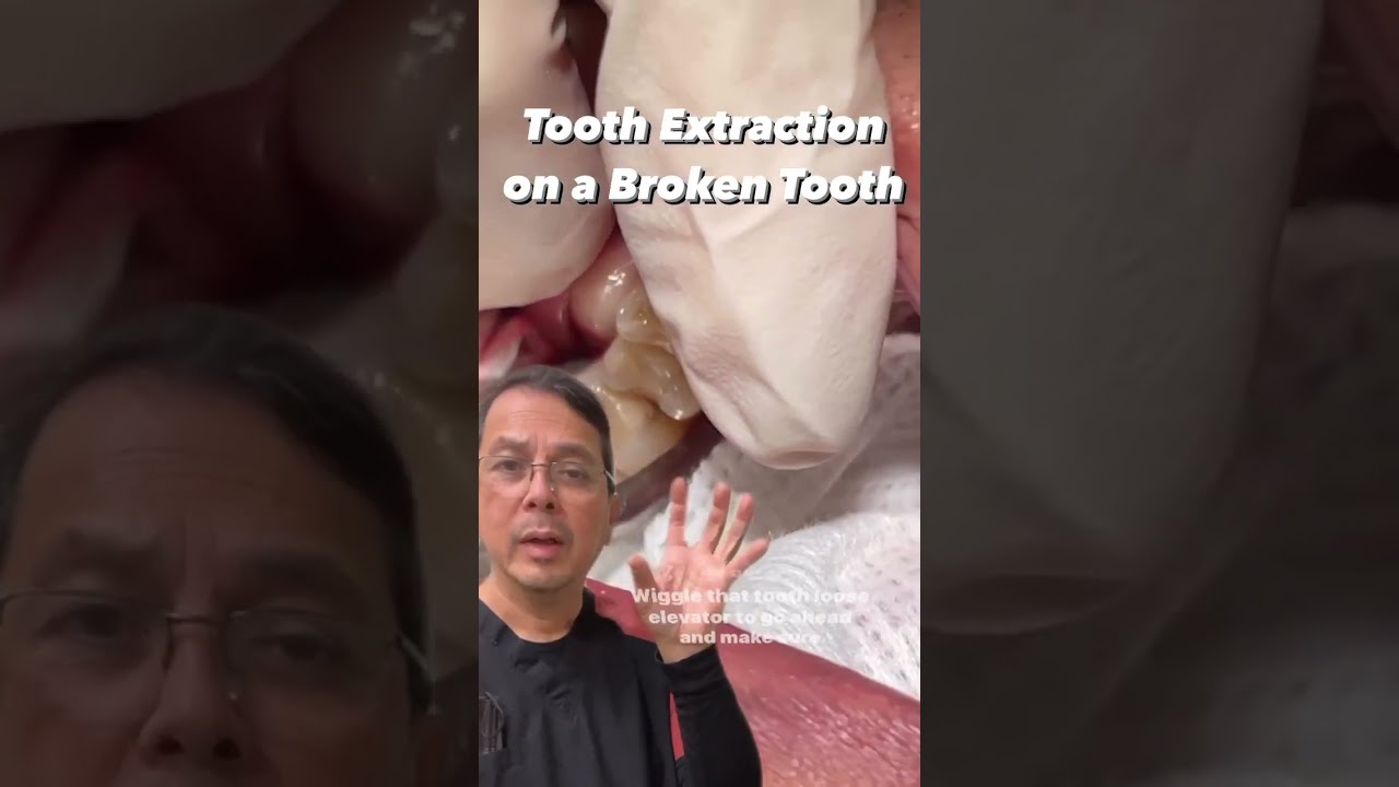 Broken Tooth Extraction Step By View Mobile Dental