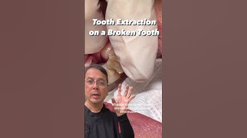Broken Tooth Extraction (Step-By-Step) | View Mobile Dental